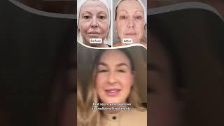 Educational Hifu liftera eye lifting treatment  #hifu #eyelift #medispa  #beautybrands #gybaio