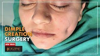 How To Get Dimples Quickly ? Permanent Dimple Creation Surgery By Dr. Prashant Yadav | Dezire Clinic