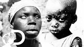 The Eradication Of Smallpox | Invisible Killers