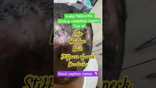 Scalp follicultis |dermatologist in Punjab| #boils #scalp infection #parisaskinclinic #drashimagoel