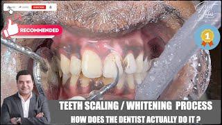 Teeth Scaling Before After | Tartar Removal | Teeth Whitening | Dental Cleaning | Teeth Cleaning