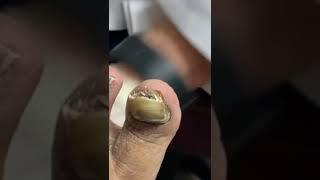  CRUMBLY, FUNGUS INFECTED TOENAIL CUTTING! #shorts #nailcutting