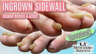 Pedicure Tutorial: How to Cut Long Curled Trumpet Toenails - Throwback