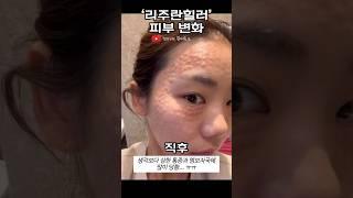 리쥬란힐러 2cc 2일간의 피부 변화 #리쥬란힐러#피부과#안티에이징