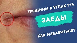 Трещины в углах рта. Заеды. Как избавиться?