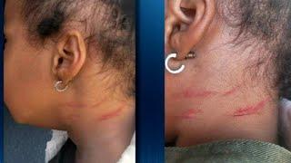 Local grandmother claims granddaughter received scratches at day care | WSB-TV
