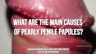 What are the Main Causes of Pearly Penile Papules?