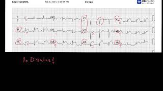 Wraparound Left Anterior Descending Artery (LAD)