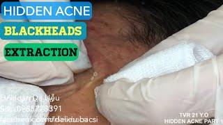 Nặn mụn nhọt ẩn đầy mặt cho nam sinh viên|Squeeze  pimples, anti acne severe blackheads part 1