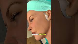 How Mini Facelift Surgery Is Performed? (3D Animation)| explained in 60 seconds #facts#face#facelift