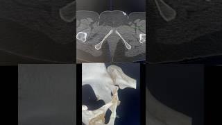 Pubic ramus fracture #fracture #pelvic #anatomy #ctscan #shorts
