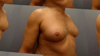 What Causes Breast Development in Men?