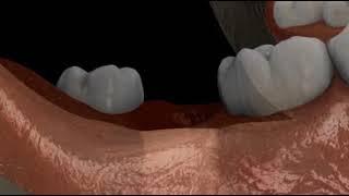 Implant In 2 step Posterior