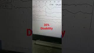 Hearing Test#bera test for hearing disability benefits