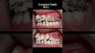 #trending #dental #dentalclinic #orthodontist #dentition #smile #dentist #shorts #bds #youtubeshorts