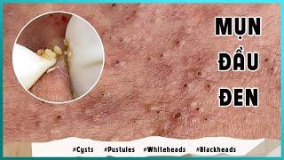 Big Cystic Acne Blackheads Extraction Blackheads & Milia, Whiteheads Removal Pimple Popping