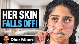 Girl Whose SKIN FALLS OFF! | Dhar Mann Studios