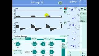 Volume Control vs. Pressure Control on Mechanical Ventilation