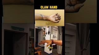 "Claw Hand Recovery: Before vs After Physiotherapy ️ #ClawHand #RehabJourney #physiotherapy