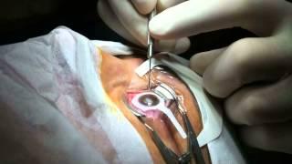 Femto LASIK - Studio Oculistico d'Azeglio, Bologna