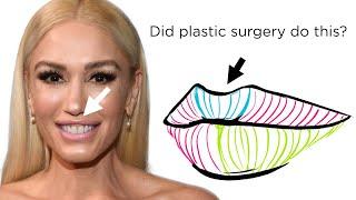 What Happened to Gwen Stefani’s Face? Newport Beach Plastic Surgeon explains