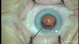 Zonulolysis during phacoemulsification