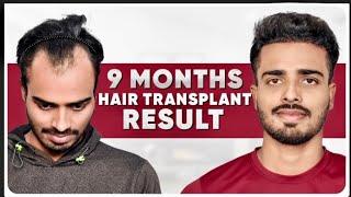 Amazing Result in 9 Months | Best Hair Transplant Clinic in India