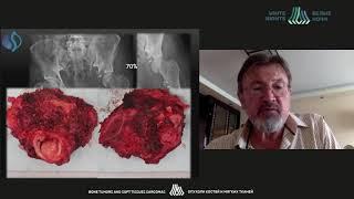 Reconstruction method of the acetabulum (Valeriy Teplyakov)