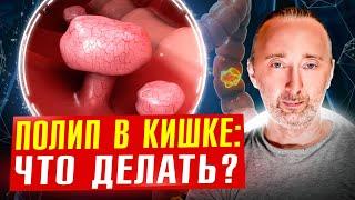 ОН защитит Вас от Полипов и РАКа Кишечника? Устраните причину!