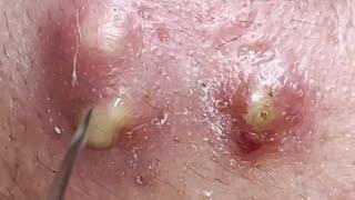 Removing pus from juicy pimples || Relaxing spa video #11