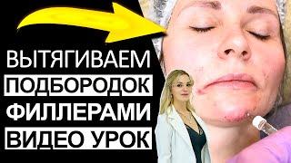 Делаем худое лицо - вытягиваем подбородок филлерами, видео урок