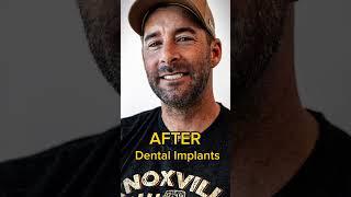 Before And After Extreme Smile Transformation In Just 24 Hours  #shorts