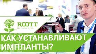 Установка зубного имплантата.   Уникальная техника установки зубного имплантата. ROOTT