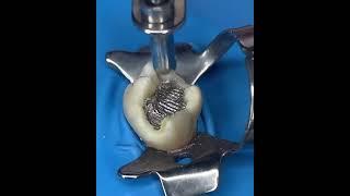 Tooth Fillings: The Good, The Bad & The Ugly