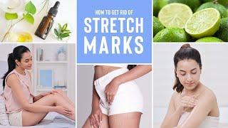 Everything You Need To Know About Stretch Marks & How To Reduce Them Using Natural Ingredients