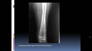 Particularities in the surgical management of pathological femoral fracture related Gaucher disease