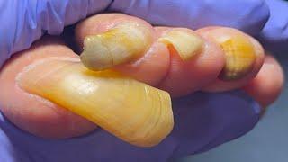 Extremely Long Toenails, Easy To Trim, Great!【Pedicure King】