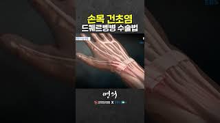 My wrist is tingling! DeQuervain Syndrome Surgery