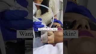 Acne Scar Treatment | Welona Clinic Chennai