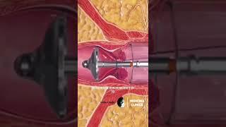 Hemorrhoids surgery 3D #3d #shorts #short #viral #trendingshorts