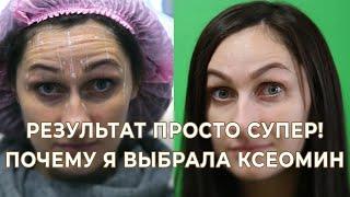 Ботокс.Диспорт.Релатокс.Ксеомин. Все о ботулинотерапии, отзыв до и после