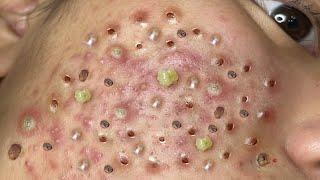 Loan Nguyen Acne Treatment 5q