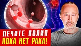 Полипы в кишечнике: как выявить и растворить без операции?