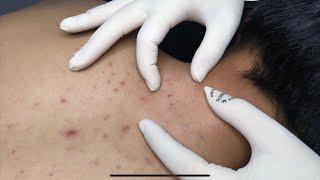 ACNE TREATMENT WITH VU QUYNH MI | Acne on Back & Chest 2023(p1)