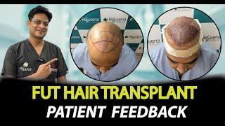 Grade 8 Hair Transplant Surgery | Rejuvena Cosmo Care Jaipur | Dr. Deepesh Goyal (Cosmetic