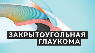 ️ ОТ ЭТОГО МОЖНО ОСЛЕПНУТЬ! ️ Закрытоугольная глаукома: симптомы, причины, лечение Доктор Лапочкин