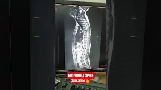 MRI WHOLE SPINE #mri #spine #radiology #pain #spinalcordinjury #backpain #doctor #ytshorts