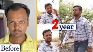 My Hair Transplant Result || Life Change After 2 Year || Patient is enjoying his life