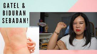 Cara Mengatasi Biduran & Gatal-Gatal (Urticaria) + Giveaway!