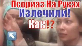 Как Лечить Псориаз На Руках-Смотрите!